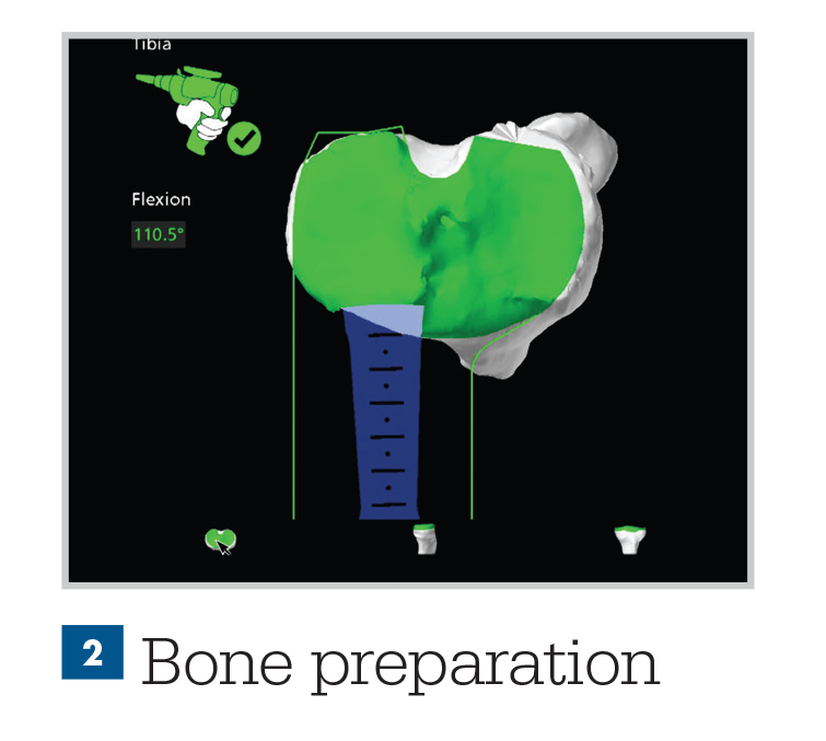 MAKO (Robotic Assisted) Total knee replacement